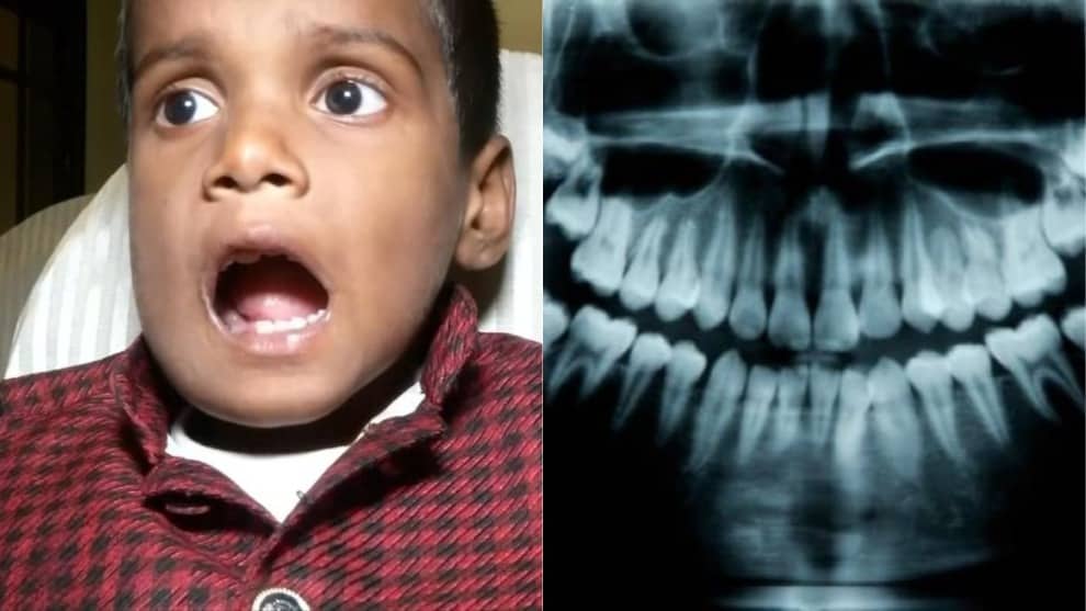 Extraen más de 500 dientes de la boca de un niño