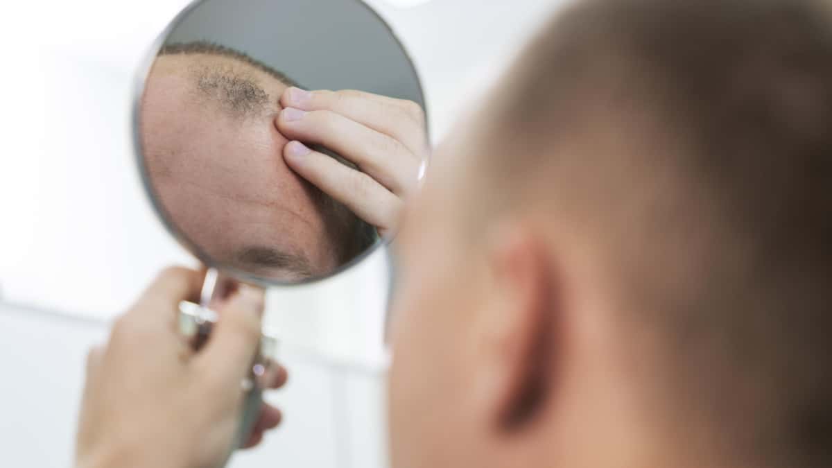 Alopecia / Foto: Freepik Aprueban pastilla para combatir la alopecia en EE. UU.