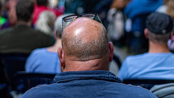 ¿Sufre de calvicie? Candidato presidencial promete financiar tratamientos para la alopecia ¿Sufre de calvicie? Candidato presidencial promete financiar tratamientos para la alopecia