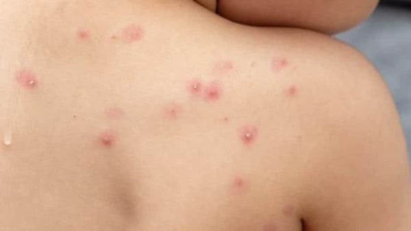 Viruela del mono: los casos registrados en el mundo ascienden a más de 50.000