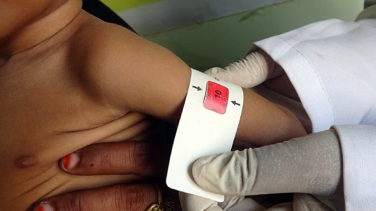 Cerca de 200 niños murieron de hambre en hospitales de Tigré en Etiopía