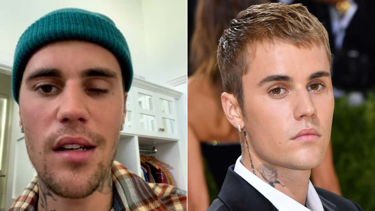 Justin Bieber y la enfermedad que le paralizó la cara