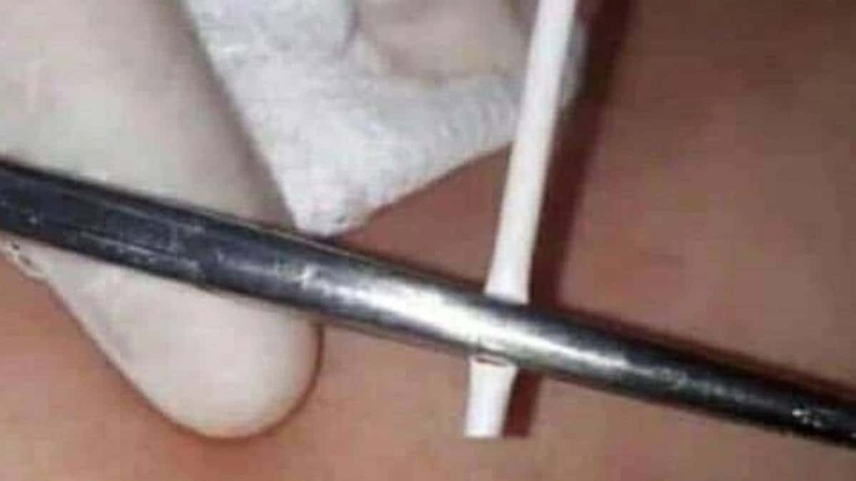 Implantaba palillos como método anticonceptivo