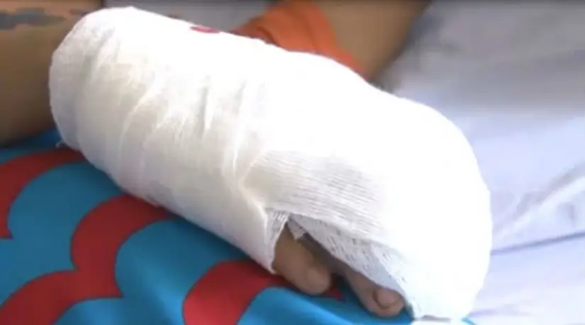 El Instituto Nacional de Salud reporta que en todo el país van 398 casos de quemados.