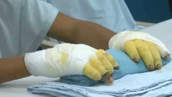 Los ataques con ácido no paran en Bogotá: 35 casos fueron por violencia intrafamiliar