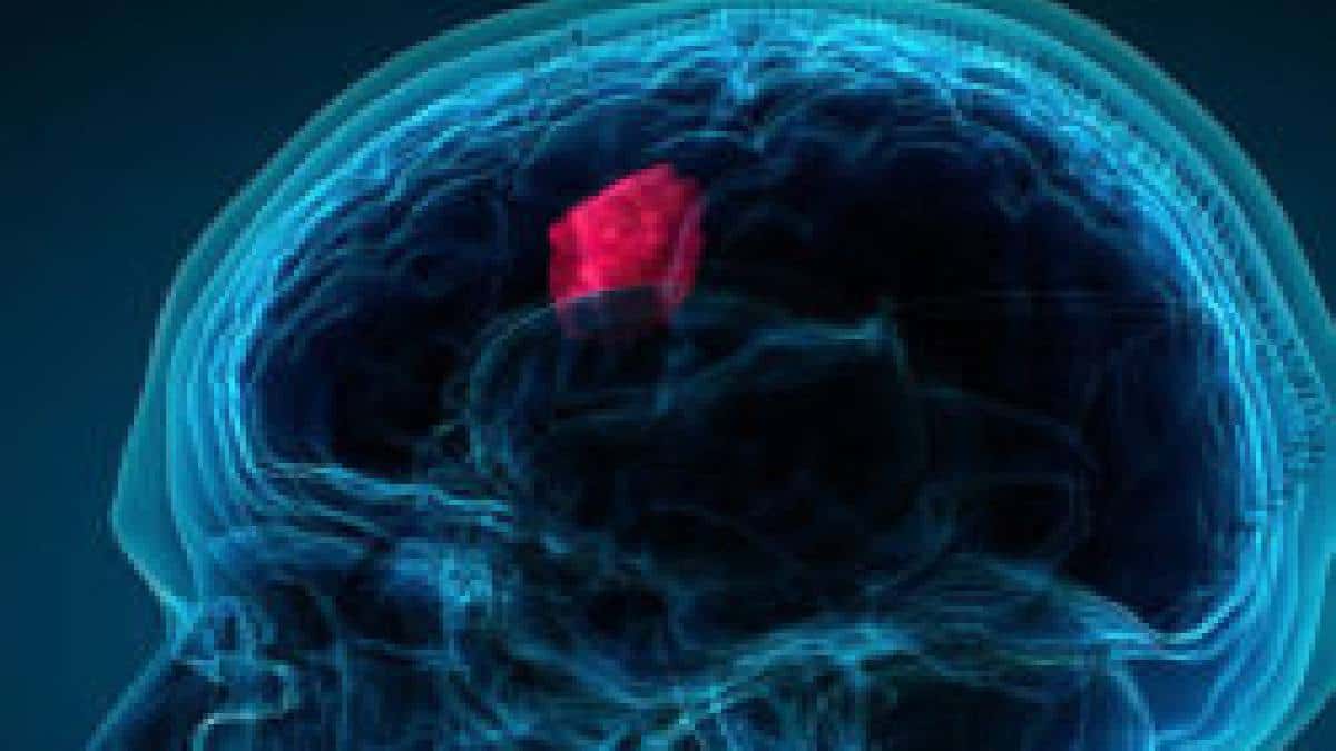 Tumor /Foto: Comunicado de prensa* Tumor