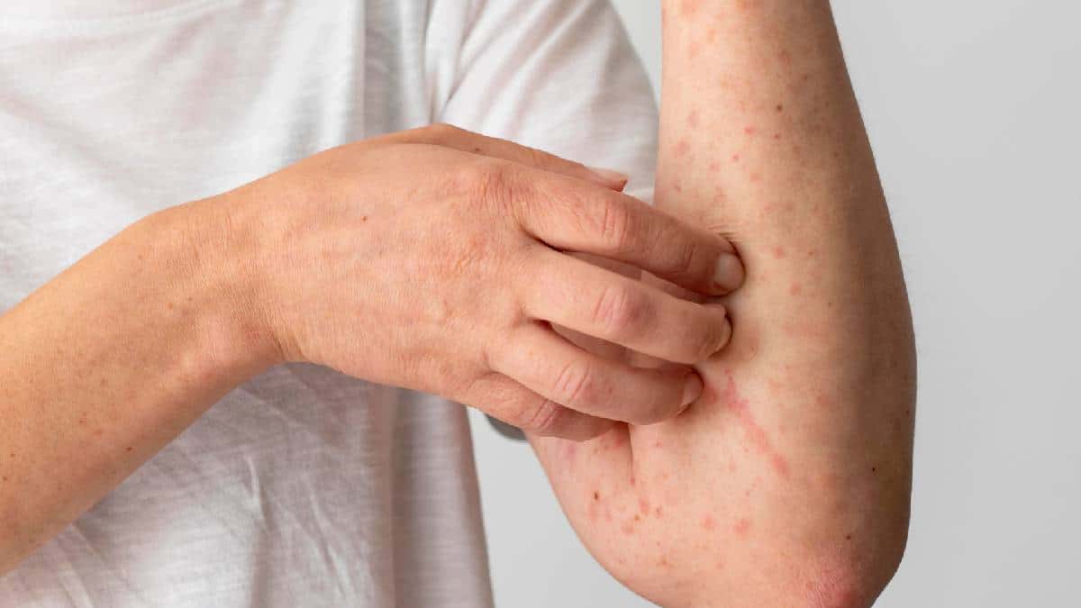 Attention: Colombia confirms first case of monkeypox (mpox clade Ib) in Antioquia