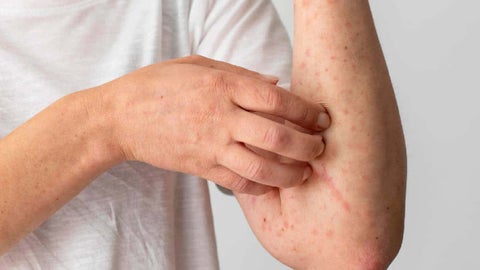 EEUU declara emergencia por viruela del mono