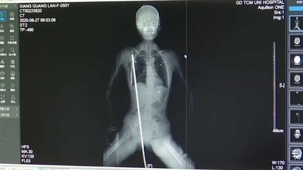 Mujer atravesada por varilla en accidente