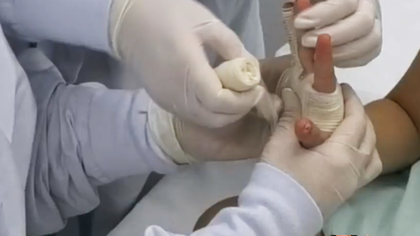 Bebé de un año resultó quemada con pólvora en Antioquia