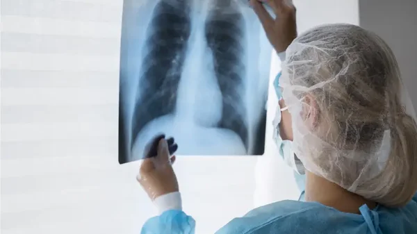 Día Mundial de la Tuberculosis: factores de riesgo, síntomas y cómo combatir esta enfermedad Día Mundial de la Tuberculosis: factores de riesgo, síntomas y cómo combatir esta enfermedad