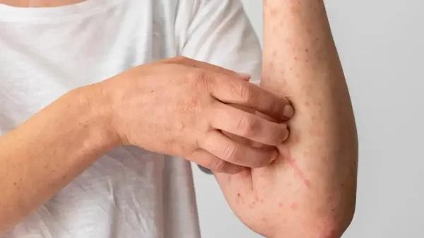 Bogotá podría declarar el fin del brote por viruela del mono