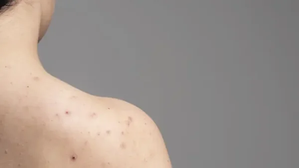 ¿Qué es la foliculitis y cuál es la forma más efectiva de combatirla? ¿Qué es la foliculitis y cuál es la forma más efectiva de combatirla?