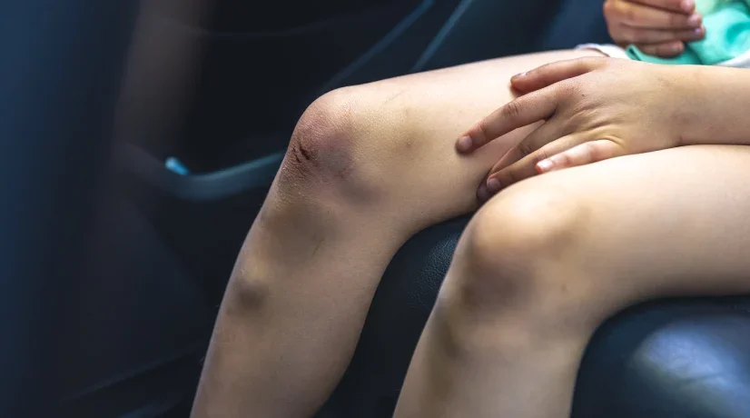 ¿Por qué salen moretones en el cuerpo? esta es la vitamina que le hace falta