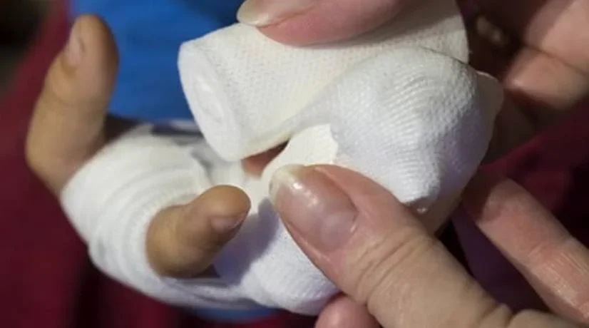 Niño perdió una mano por manipular una bengala