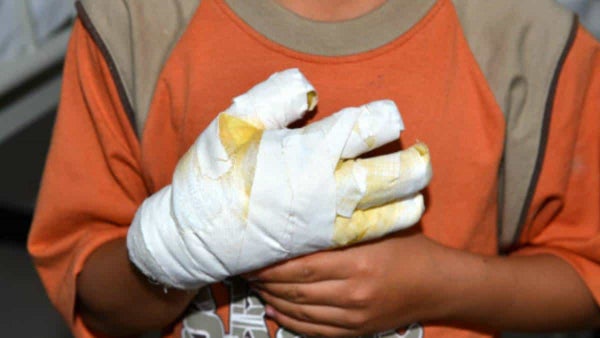 El INS busca prevenir muertes por pólvora tras el fallecimiento de dos niños en 2024 El INS busca prevenir muertes por pólvora tras el fallecimiento de dos niños en 2024