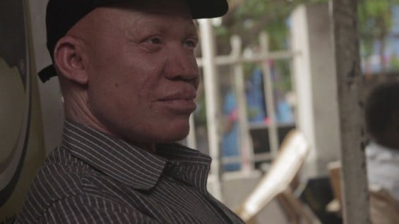 Josephat Torner, albino de 32 años. Foto: AFP