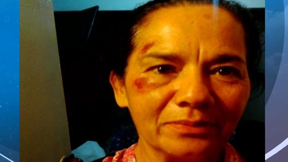 Gloria Cruz sufrió graves luego de caer en un hueco de una de las láminas que conforman el piso de las estaciones de Transmilenio. Foto Noticias RCN