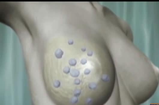 El autoexamen es fundamental para atender el cáncer a tiempo.