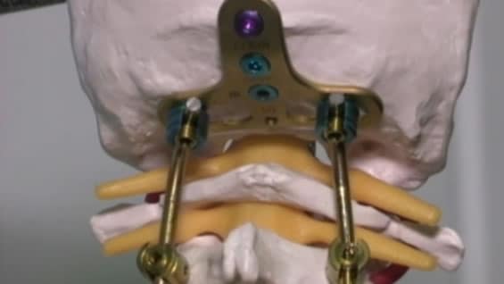 Protesis fabricadas a medida por Mediimplantes. Foto: Noticias RCN