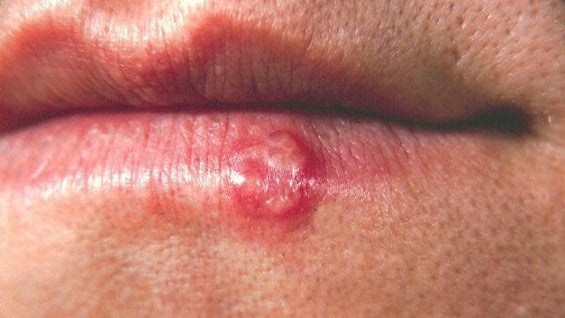 En Europa, el 69% de las mujeres de menos de 50 años tienen el virus.