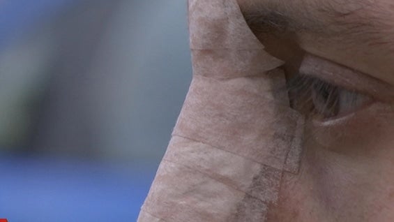 El joven agredido sufrió de una fractura en la nariz. Foto: NoticiasRCN