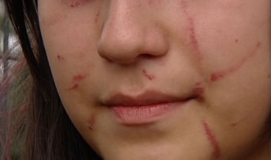 La estudiante de 13 años recibió rasguños y golpes por parte de 10 compañeras de colegio en Bogotá. Foto: Noticias RCN