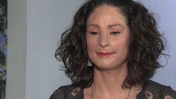 Natalia Ponce de León es símbolo de la lucha contra los ataques con ácido. Foto: NoticiasRCN.com