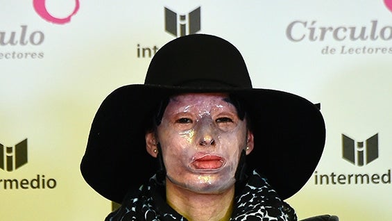 El rostro de Natalia Ponce de León estaba cubierto por una máscara de silicona para evitar infecciones. Foto: AFP.