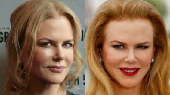 Nicole Kidman dijo que no volverá a usar botox.
