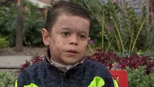 Yalik Peña, de 19 años, fue diagnosticado con la enfermedad desde el momento de su nacimiento. Foto: NoticiasRCN.com