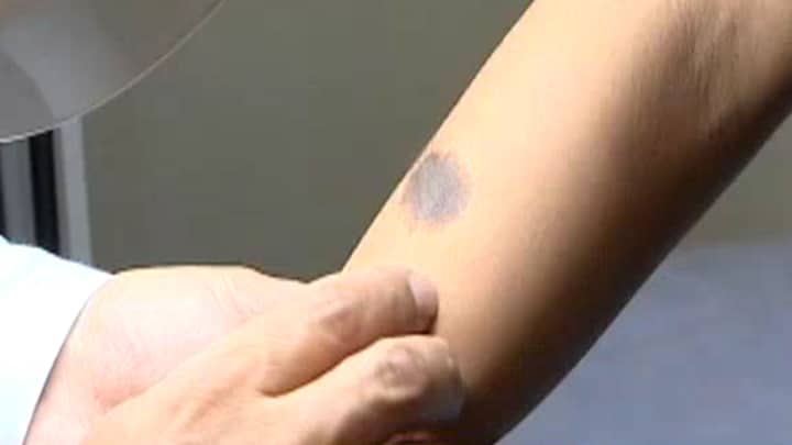 La mayoría de adultos presenta entre 30 y 40 lunares.