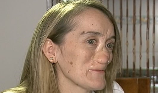 Nayibe Sáenz sufrió un tumor cancerígeno a los 16 años.