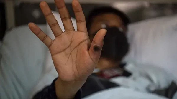 Viruela del mono: Ministerio de Salud confirmó que se firmó el memorando para las donaciones de Japón