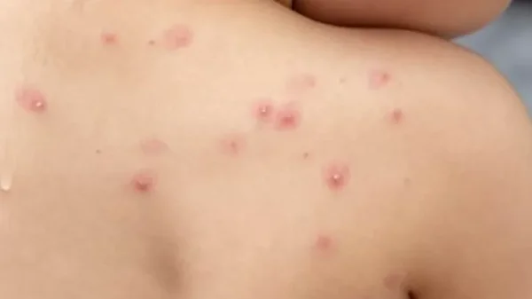 Confirman que ya son más de 4.000 casos de viruela del mono en Colombia Confirman que ya son más de 4.000 casos de viruela del mono en Colombia