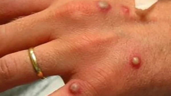 Quedó claro: siga estos pasos para no contagiarse con la viruela del mono