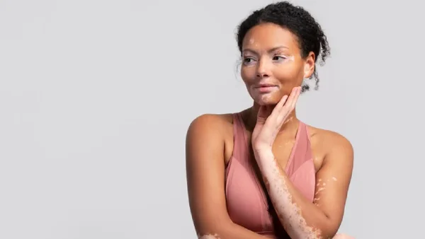 ¿Qué es el vitíligo? Recomendaciones para prevenir y cuidar esta enfermedad