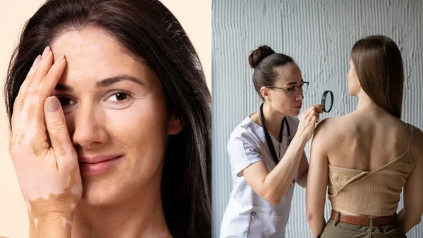 ¿Qué es el vitíligo y por qué afecta la piel?