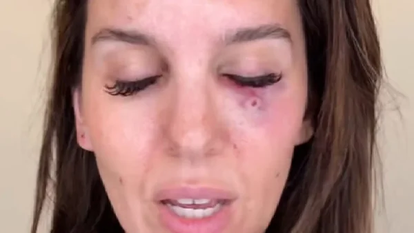 Actriz con paso por Disney casi pierde uno de sus ojos en un accidente: ¿qué pasó? Actriz con paso por Disney casi pierde uno de sus ojos en un accidente: ¿qué pasó?