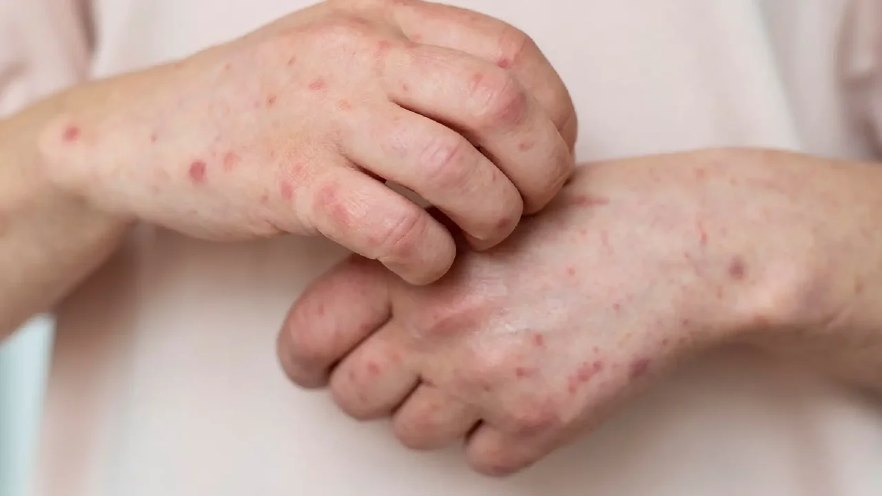 Measles: A Persistent Public Health Surveillance Challenge
