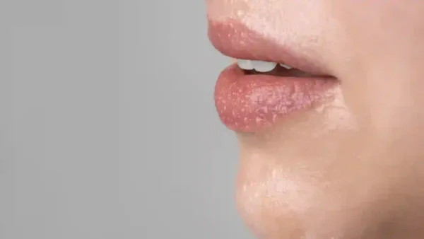 ¿El herpes labial podría ser un factor silencioso en la aparición del alzhéimer? ¿El herpes labial podría ser un factor silencioso en la aparición del alzhéimer?