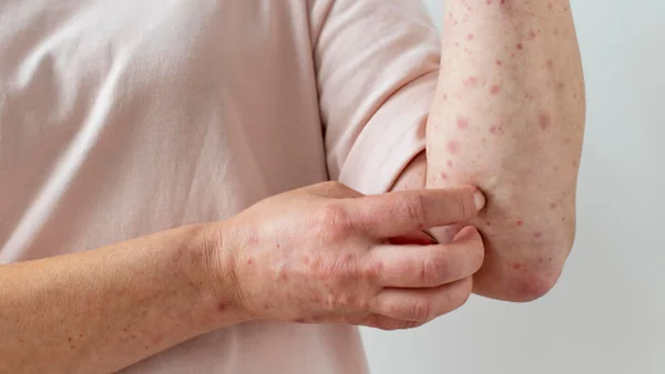 Europa reporta un alarmante aumento en el número de casos por sarampión