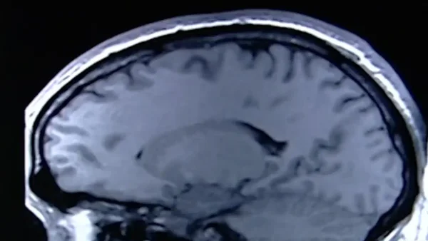 Experto explica en qué consiste la cirugía a la que debe someterse Miguel Uribe