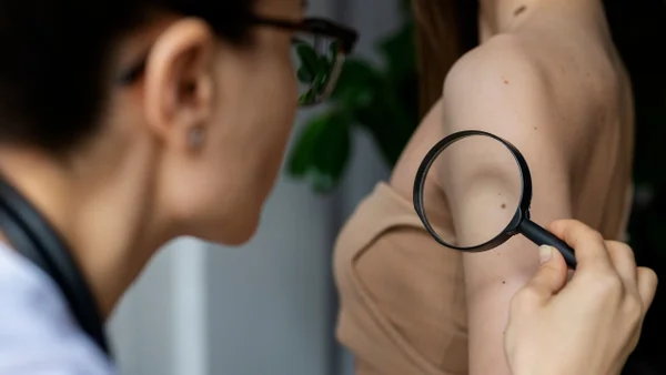 Cáncer de piel: identifican proteína clave que permite al melanoma expandirse