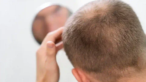 Avances de la alopecia sin cirugía en Colombia