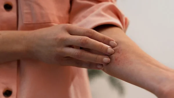 10 técnicas sencillas para prevenir y tratar las picaduras de insectos, según expertos 10 técnicas sencillas para prevenir y tratar las picaduras de insectos, según expertos