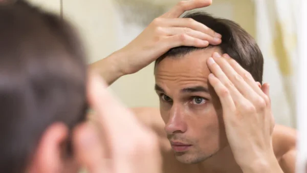 ¿Por qué los hombres presentan alopecia a temprana edad? esto dicen expertos