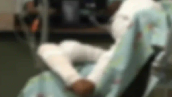 Niño quemado en el 95% de su cuerpo con gasolina: investigan caso de maltrato infantil