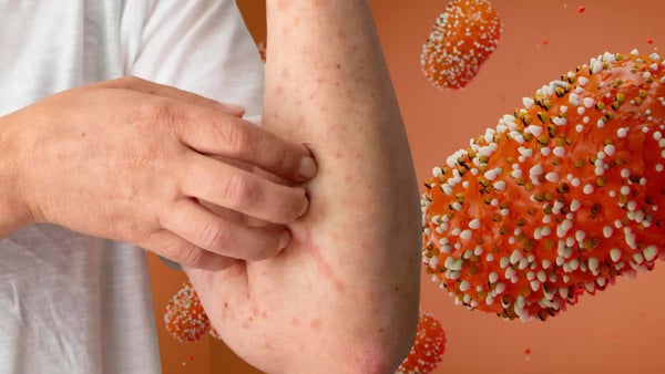 Barrancabermeja registra su primer caso de viruela del mono ¿Qué síntomas son de alarma?