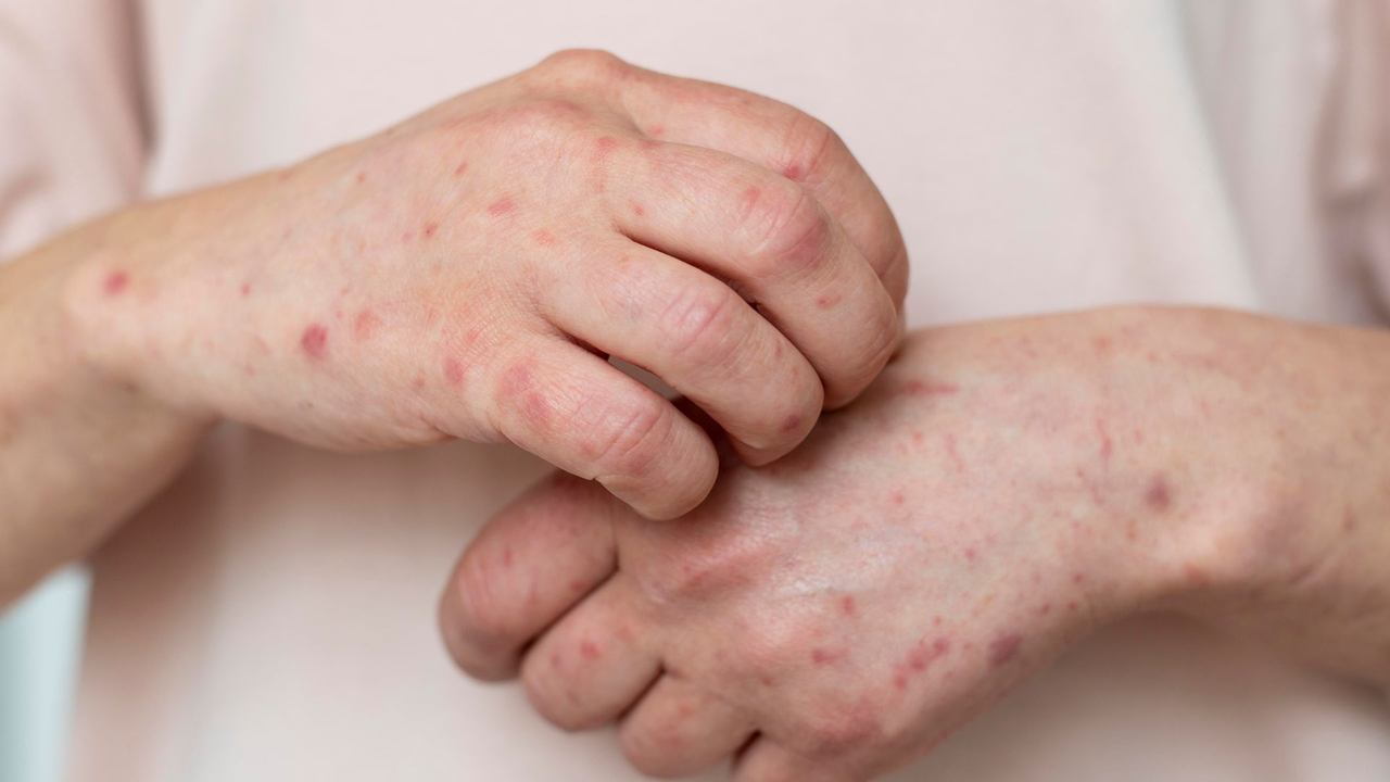 Measles: Symptoms, Causes, and Main Risk Factors in the Population